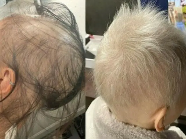 モデルナ接種後、脱毛症状が出ていた日本女性の驚くべき近況＝韓国報道（画像提供:wowkorea）