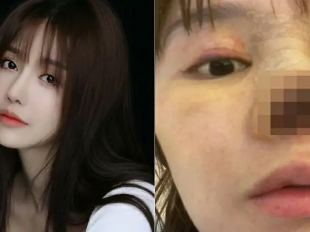 2月に鼻先の壊死を告白し、世界に衝撃を与えた中国の女優・高溜(ガオ・リュウ)