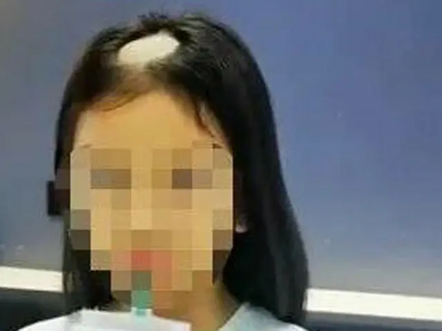 中国で、猫を飼い始めて1週間で円形脱毛症が大きく広がってしまった少女が話題に