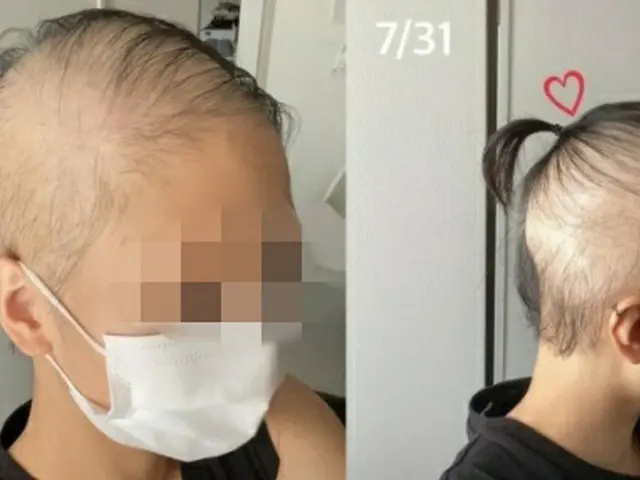 モデルナ製ワクチンの1回目接種後に脱毛し始めたという日本の20代女性、韓国でも報道