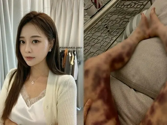 健康増進のための注射を受けた後に青あざができた韓国の美女ユーチューバーAORI、ネットユーザーからのアドバイスを受けて大学病院で検査を受ける