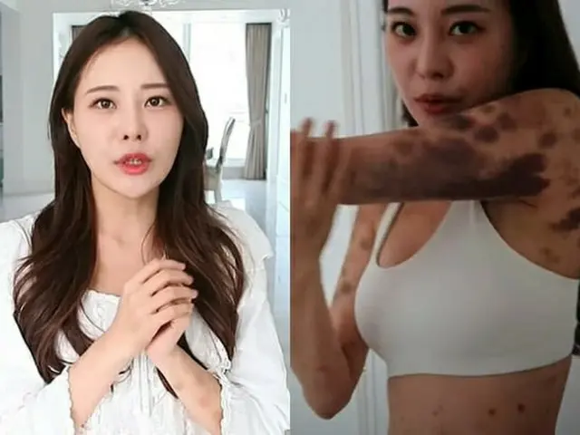健康増進注射で全身に“青あざ”ができたことを明かした美女ユーチューバーAORI、「回復に努めている」と報告