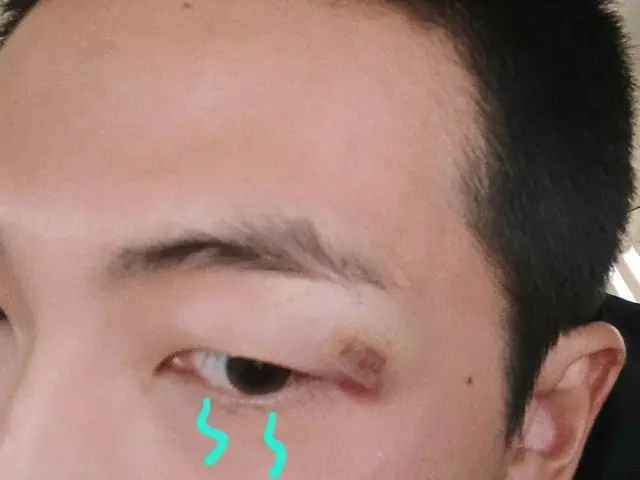 RM（BTS）、眉の下にできた傷を公開してファンが心配。