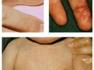 手足口病で乳幼児2人死亡　保健当局が注意呼び掛け＝韓国