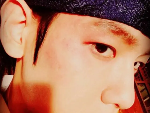 BAEK HYUN（EXO）はカメラに向かってあざができた頬のセルフショットを公開した（提供:OSEN）