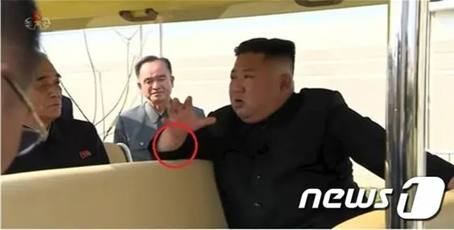 北朝鮮の金正恩委員長の手首にある“黒い跡”は、心臓関連手術に関するものではという可能性が話題となっている（提供:news1）