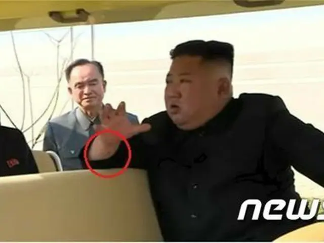 北朝鮮の金正恩委員長の手首にある“黒い跡”は、心臓関連手術に関するものではという可能性が話題となっている（提供:news1）