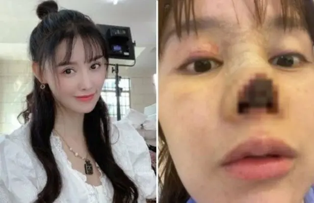 中国女優の高溜(ガオ・リュウ)、鼻整形後に”壊死”…写真公開し韓国でも話題に（画像提供:wowkorea）