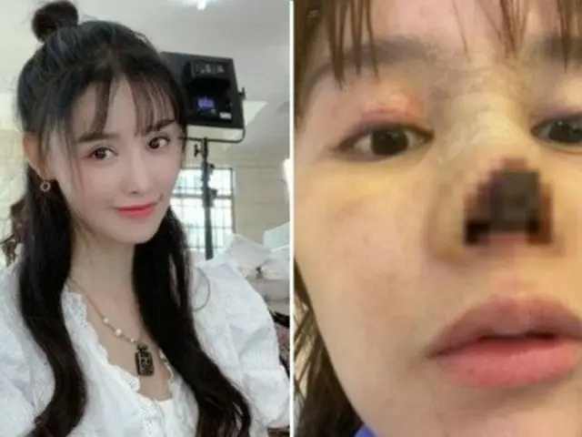 中国女優の高溜(ガオ・リュウ)、鼻整形後に”壊死”…写真公開し韓国でも話題に（画像提供:wowkorea）