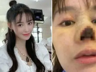 中国女優の高溜(ガオ・リュウ)、鼻整形後に”壊死”…写真公開し韓国でも話題に