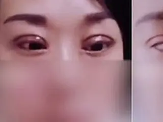 「怪物を見るように」…中国で「二重の整形手術」に失敗した女性が夫から離婚を要求される事態に＝韓国報道