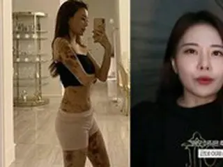 「全身に青あざ」告白の美女ユーチューバー、「手足がうまく広げられない」と明かす…法的対応へ＝韓国