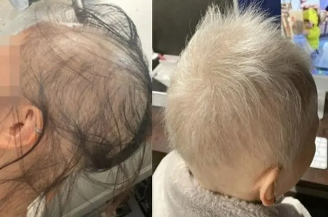 モデルナ接種後、脱毛症状が出ていた日本女性の驚くべき近況＝韓国報道（画像提供:wowkorea）