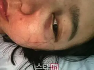 “ガールズグループ出身のインフルエンサー”ソ・サラン、あざだらけの顔をさらけ出し夫からのDV被害を訴える