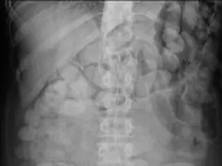 体内で麻薬袋が破れ男性死亡…韓国で初めて「body packer」確認