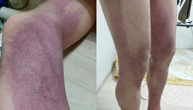 ＜梨泰院事故＞「私は生存者です」…圧迫されてできた「あざだらけ」の脚を公開（画像提供:wowkorea）