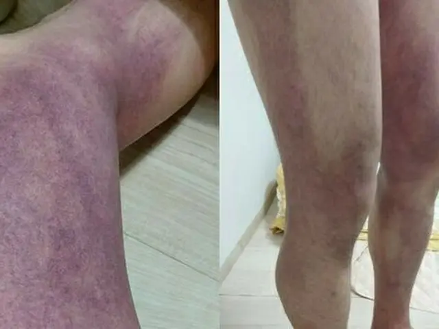 ＜梨泰院事故＞「私は生存者です」…圧迫されてできた「あざだらけ」の脚を公開（画像提供:wowkorea）