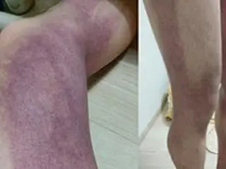 ＜梨泰院事故＞「私は生存者です」…圧迫されてできた「あざだらけ」の脚を公開