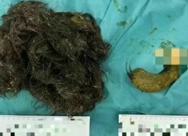 中国の14歳少女の胃腸内から「毛髪3キロ」を発見…緊急手術＝韓国報道（画像提供:wowkorea）