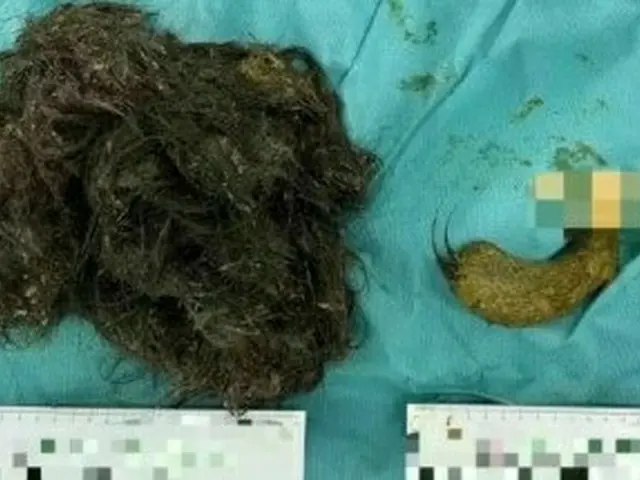 中国の14歳少女の胃腸内から「毛髪3キロ」を発見…緊急手術＝韓国報道（画像提供:wowkorea）