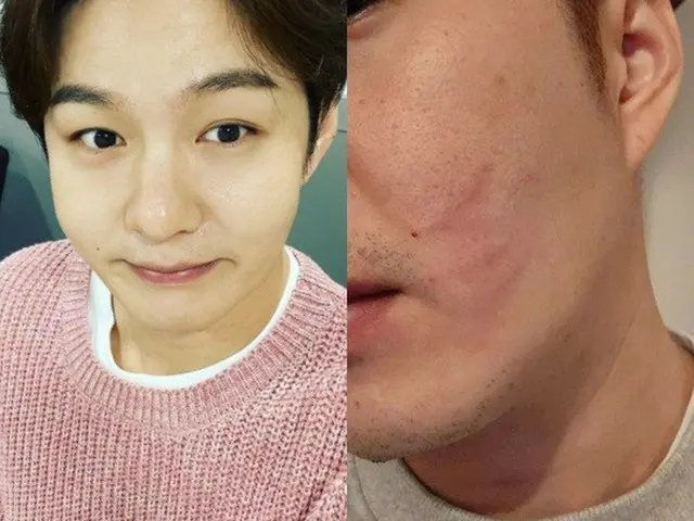 チャンソプ（BTOB）、腫れた頬の傷…犯人は「愛犬グリ」（画像提供:wowkorea）