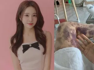 皮膚科で注射後「全身にあざ」人気ユーチューバーが勝訴＝韓国